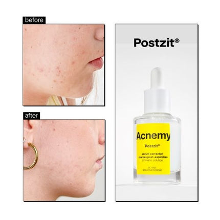 Acnemy Postzit Zit Marks Solutions