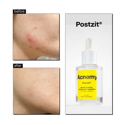 Acnemy Postzit Zit Marks Solutions